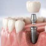 A mockup of the inner mechanism of a dental implant.