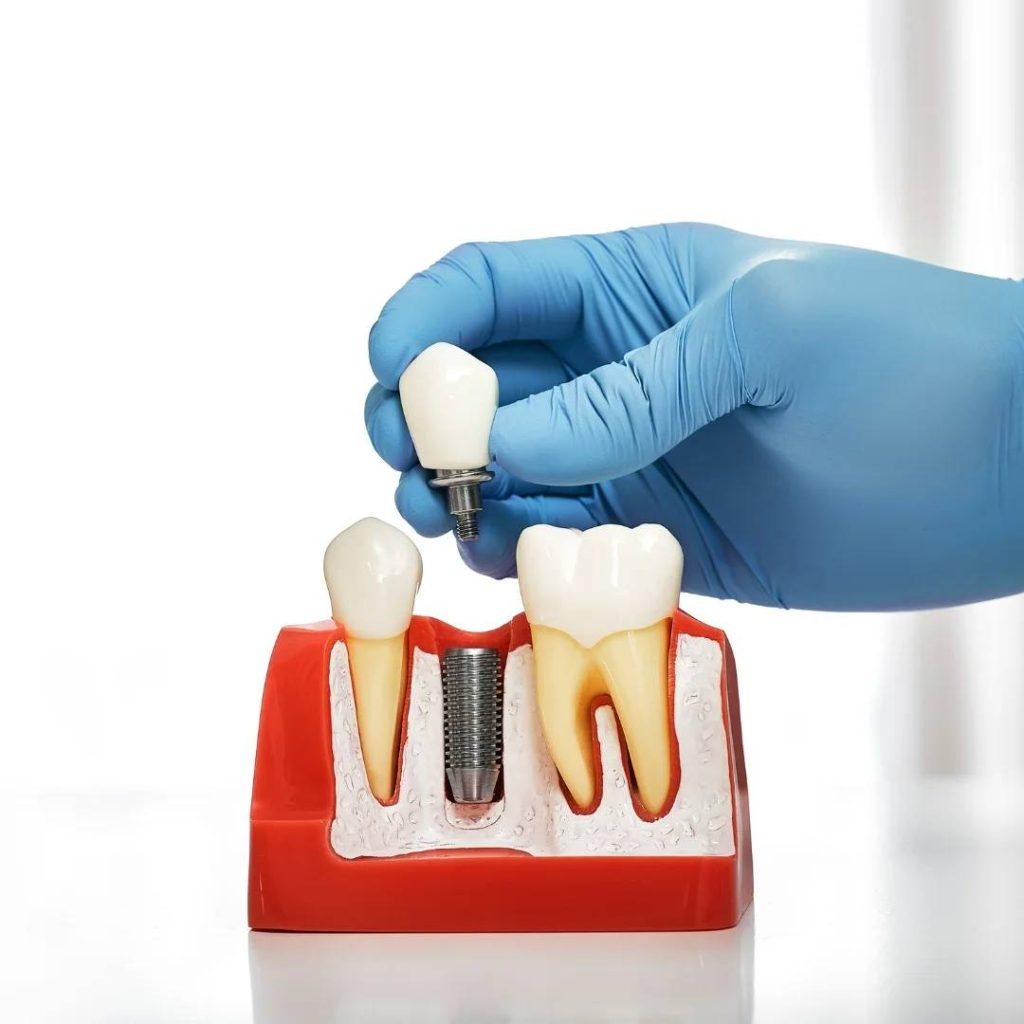 Gloved hand holds a dental implant crown above a model showing three teeth with implant fixture in center position