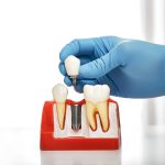 Gloved hand holds a dental implant crown above a model showing three teeth with implant fixture in center position